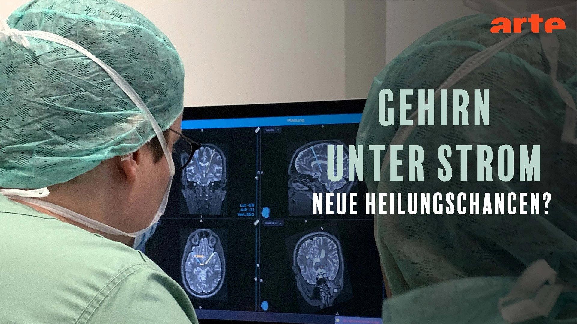Gehirn unter Strom - Hilfe bei Depression, Epilepsie und Parkinson? 2026 movie scene