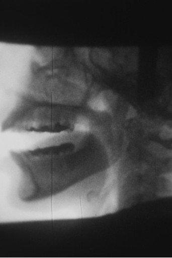 X-ray (1975) poster