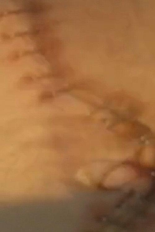 Suite: Double Nephrectomy 1998 official movie poster