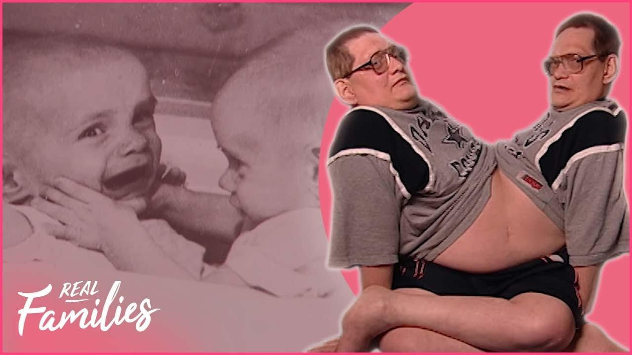 The World's Oldest Conjoined Twins Trailer